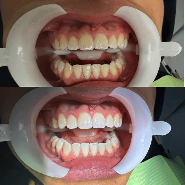 Antes y después — blanqueamiento