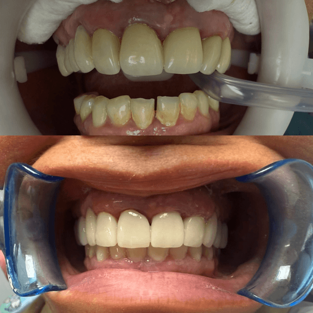 Antes y después — diseño de sonrisa