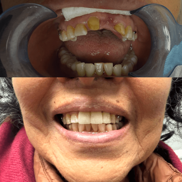 Antes y después — prótesis fija